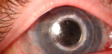 Bioninen silmä palauttaa näön sokeutuneelle