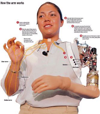 nainen, jolla on bioninen käsivarsi