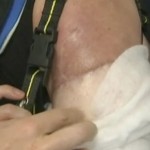 worlds-first-double-arm-transplant-patient-delighted-1
