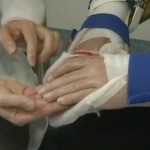 worlds-first-double-arm-transplant-patient-delighted-3