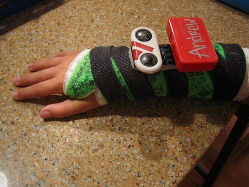 Pojan käsi murtui, tilalle laitettiin biomekaaninen Lego-komponentti 1 Pojan käsi murtui, tilalle laitettiin biomekaaninen Lego-komponentti 1