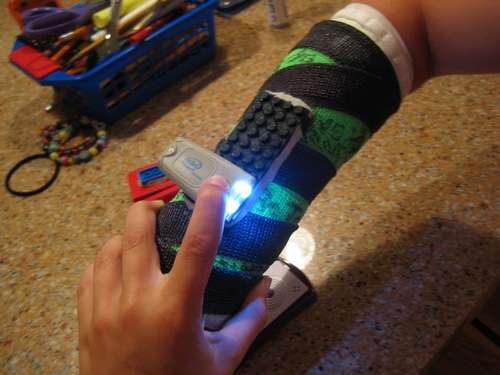 Pojan käsi murtui, tilalle laitettiin biomekaaninen Lego-komponentti 2 Pojan käsi murtui, tilalle laitettiin biomekaaninen Lego-komponentti 2