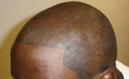 HiStyl tatuoi sängen kaljuun päähän