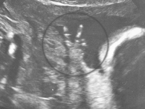 Vauva näyttää voitonmerkkiä ultraäänikuvassa