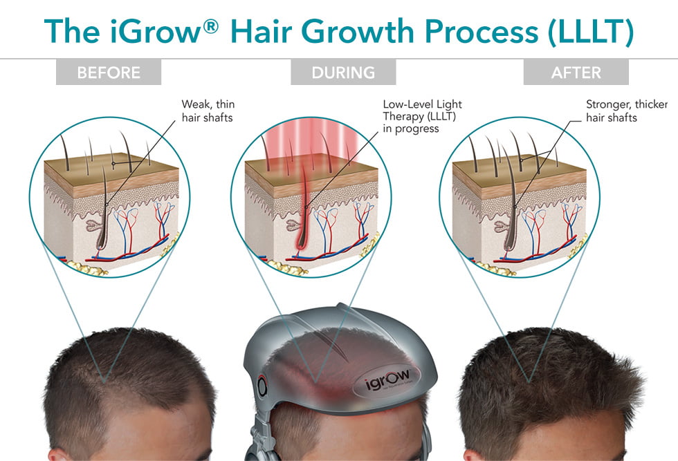 Hiuspohjan stimulointia - Low-Level Laser (Light) Therapy (LLLT) for Treatment of Hair Loss